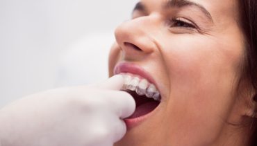 Clear Aligners / Braces
